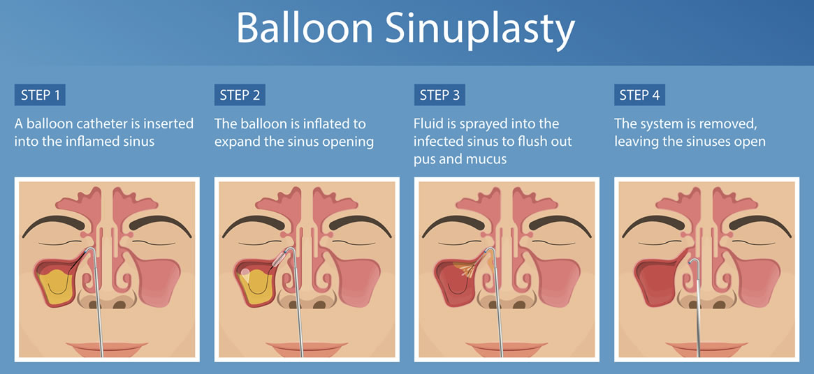 Balloon Sinuplasty Treatment Los Angeles